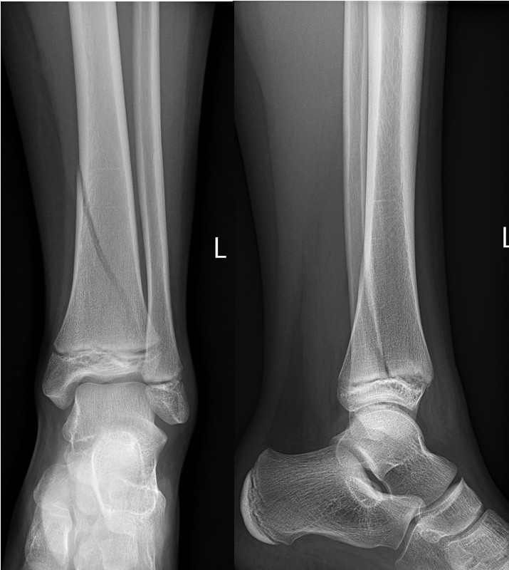 Fractures Ankle