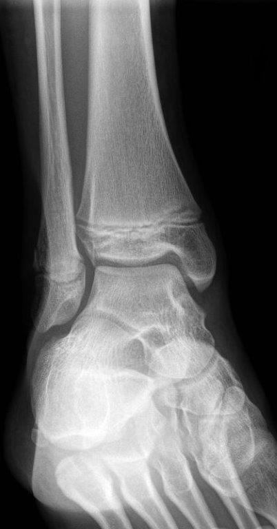 Undisplaced Salter Harris 2 fracture of fibula