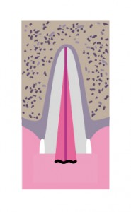 Illustration of complicated crown fracture