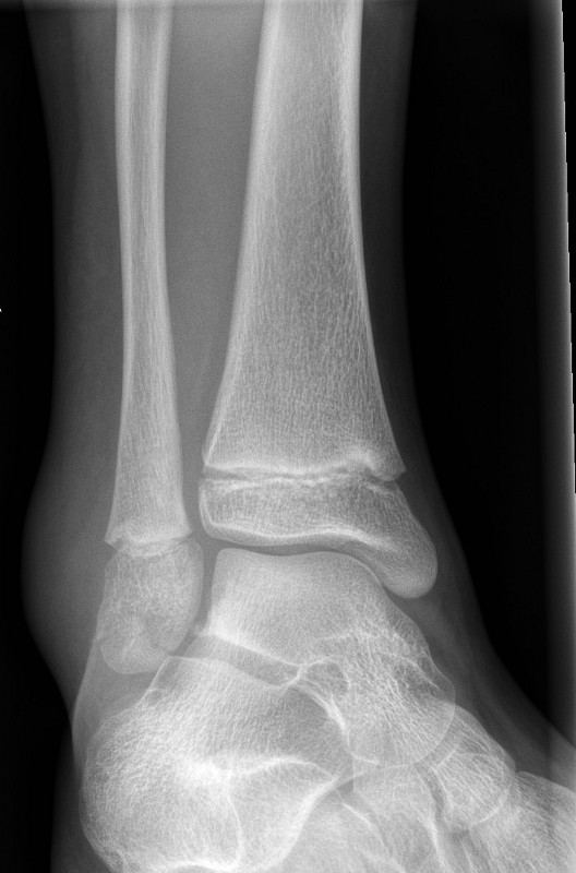 Undisplaced epiphyseal fracture of fibula
