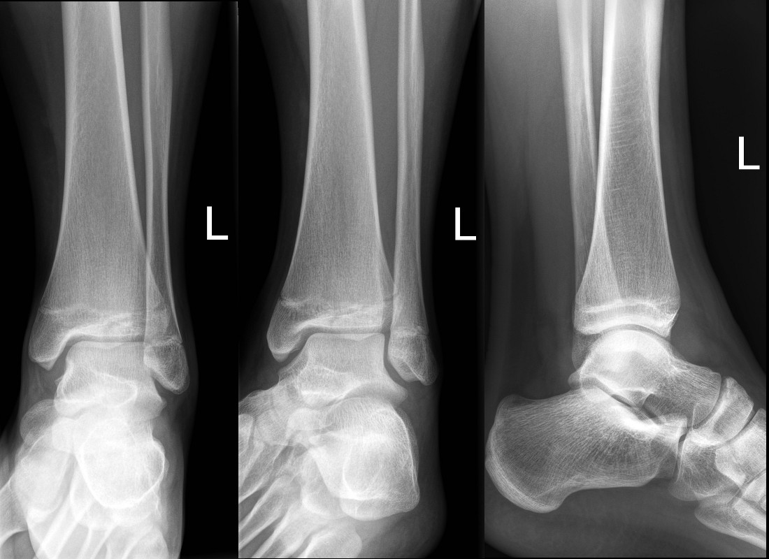 Minimally displaced Tilleaux fracture Minimally displaced Tilleaux fracture