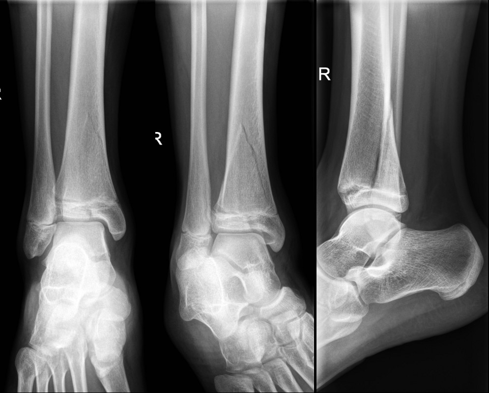 Triplane fracture of distal tibia Triplane fracture of distal tibia