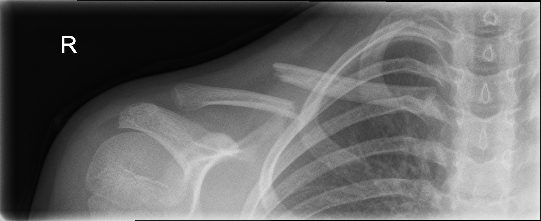 Displaced middle third clavicle fracture