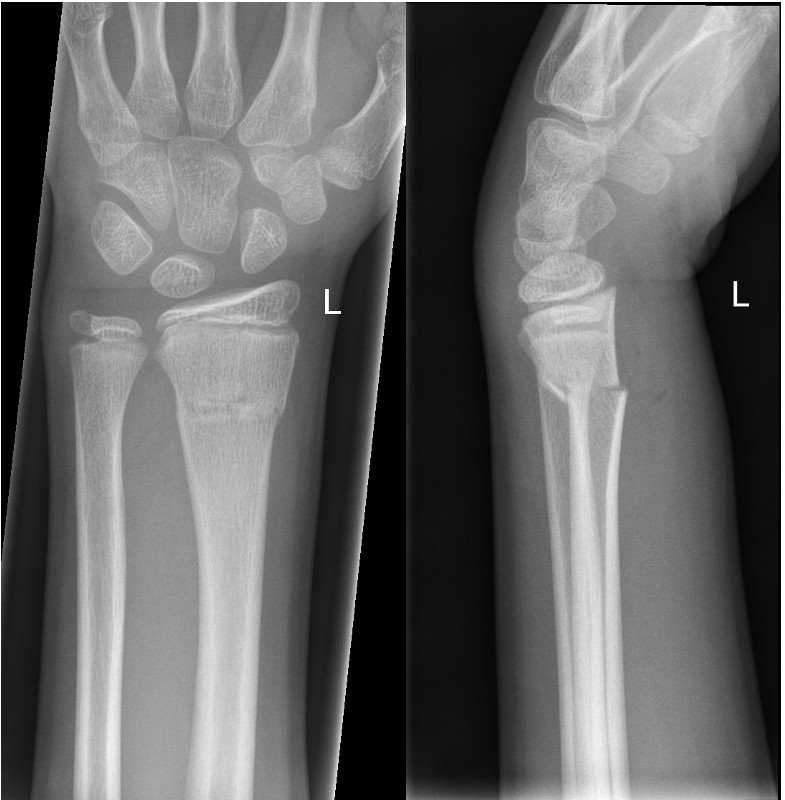 Transverse wrist with mild angulation