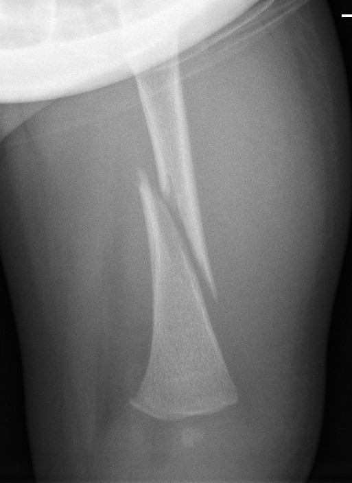 Fractures Femur