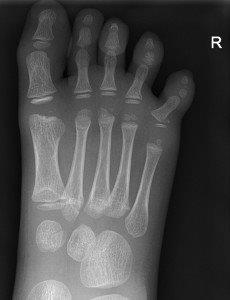 Angulated Salter-Harris II fracture of 5th proximal phalanx