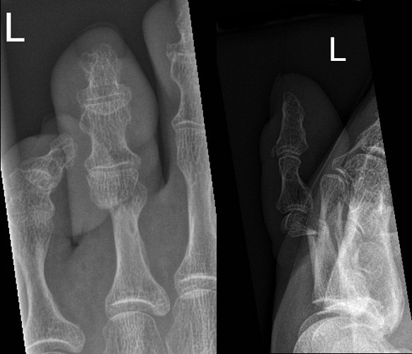 Dorsally displaced transverse fracture of neck of 3rd proximal phalanx