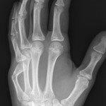 Plastic deformity of radius and ulna with volar tilt