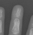 Distal tuft fractures