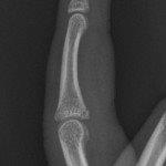 A volar plate injury 