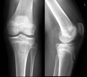 An x-ray of tibial spine showing insertion of anterior cruciate ligament