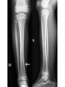 X-Ray of undisplaced transverse fracture of tibia. Highlighted by the arrow