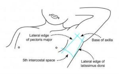 Patient position for intercostal catheter insertion 