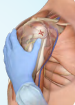 Intraosseous access via the proximal humerus – anterolateral shoulder into greater tubercle