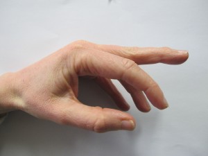 Shows a middle finger with mallet deformity