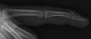 X-ray of mallet finger