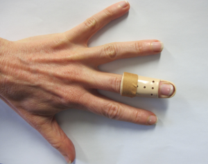 Stax splint fixed with adhesive tape to the finger just distal to the PIP joint. 