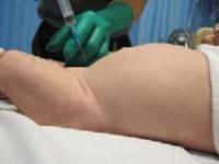 Technique to insert needle for suprapubic aspirate.